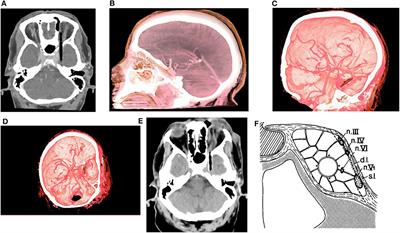 Minimally Invasive Subtemporal Intradural Approach for Penetrating Orbitocranial Injury by Wooden Foreign Body Into the Lateral Wall of the Cavernous Sinus